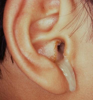 כיצד נכון להשתמש טיפות אוזניים לילדים?