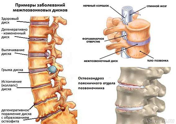 osteochondrosis ואת הצבא 