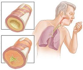 מחלת ריאות חסימתית כרונית של COPD