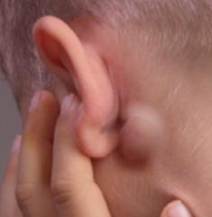מדוע בלוטות לימפה דלקת מאחורי האוזניים